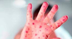 Pacientes diagnosticados con viruela del mono se encuentran en aislamiento