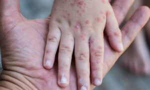 Citatorio de la Escuela Primaria de Pachuca que confirma la presencia del virus Coxsackie.
