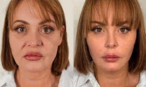 Una reconocida actriz mostró una transformación facial lograda mediante procedimientos no quirúrgicos realizados por especialistas en Brasil.