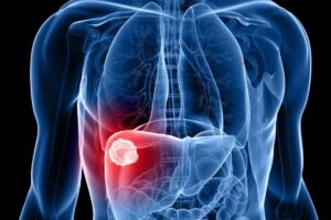 Especialistas advierten que el jarabe de maíz alto en fructosa puede provocar inflamación hepática constante.