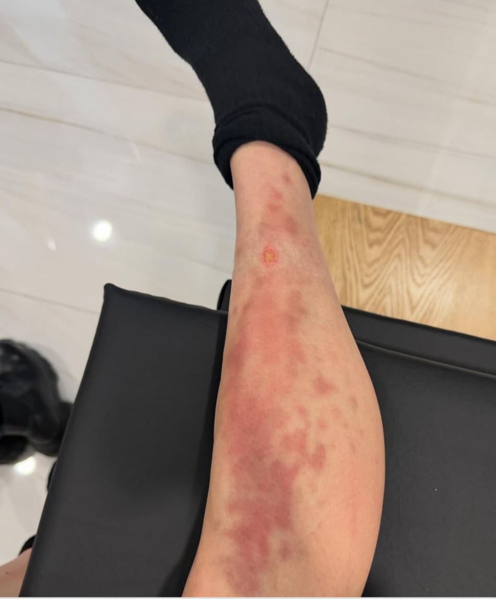 Taylor Momsen hospitalizada en Ciudad de México tras una picadura de araña venenosa, pero el show sigue